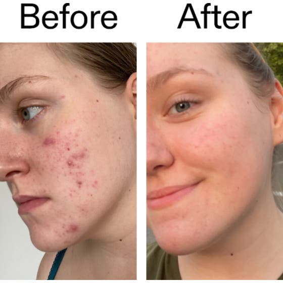 15% Vitamin C and EGF Serum