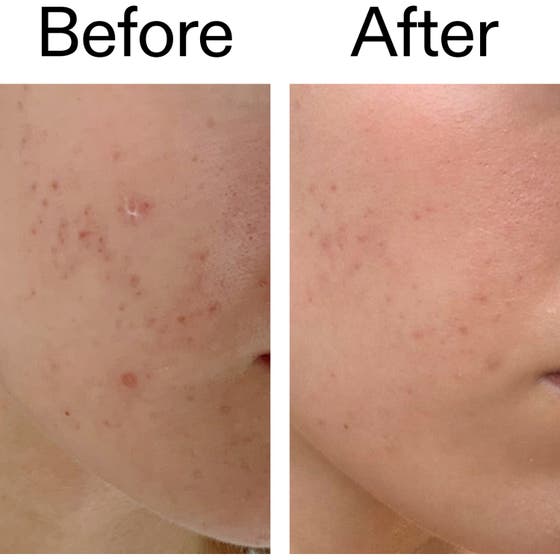 Mandelic Acid Treatment