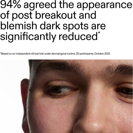 Mandelic Acid Treatment