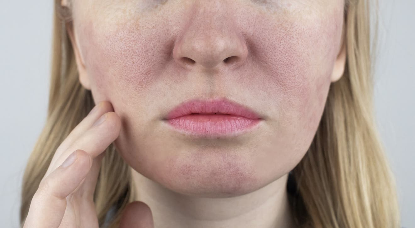 Perioral dermatit: så lugnar och balanserar du huden