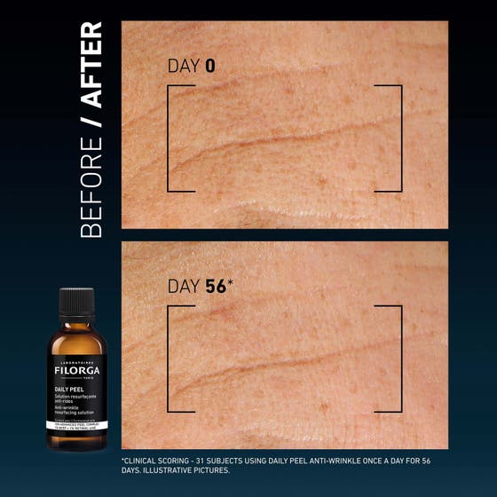 Clinical Home Peel Winkles