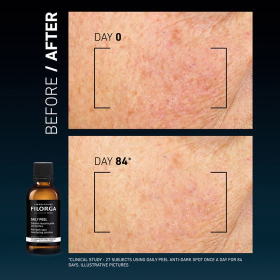 Clinical Home Peel Dark Spot