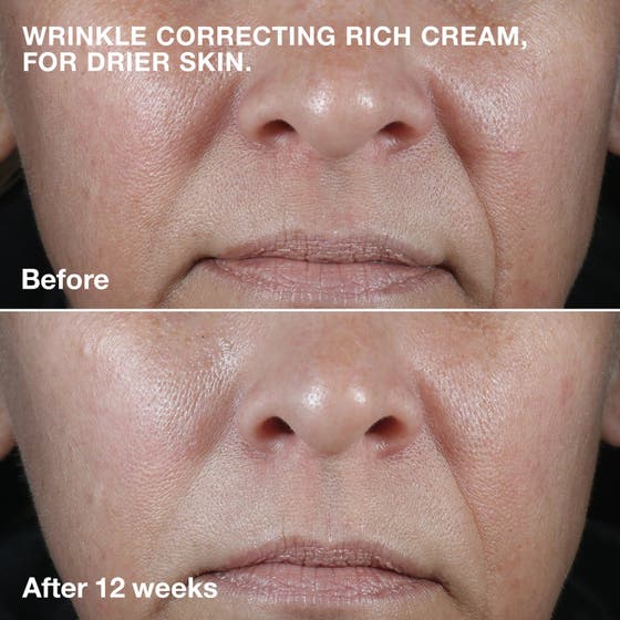 Clinique 3-Step Skincare System 450 ml hudpleje viser før og efter resultat med Wrinkle Correcting Rich Cream på rynker.