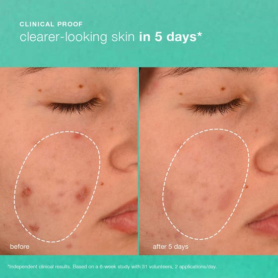 Breakout Biotic Moisturizer Duo