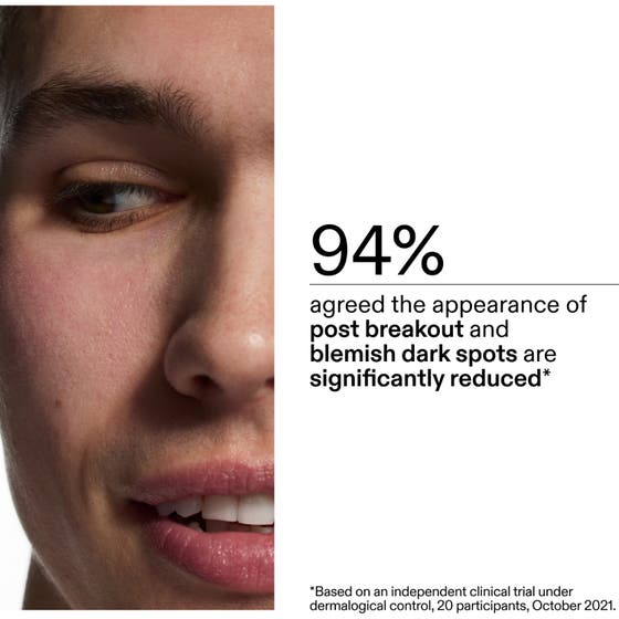 Mandelic Acid Treatment