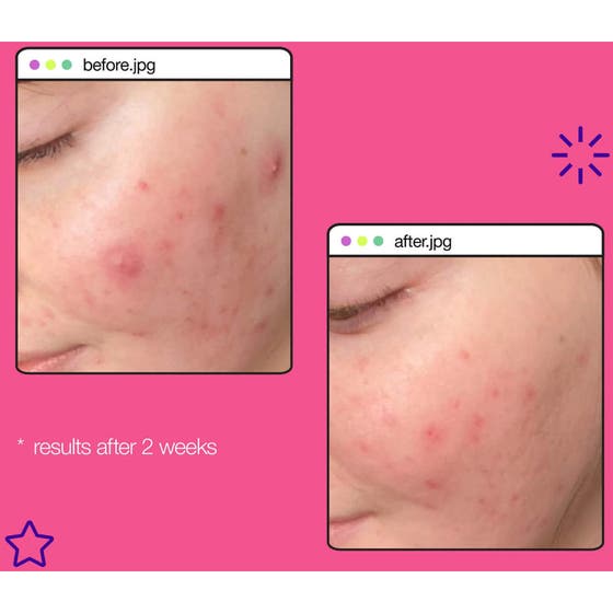 Breakout Clearing Liquid Peel