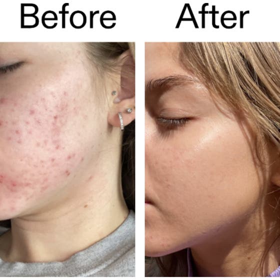 Beta Hydroxy Acid Serum