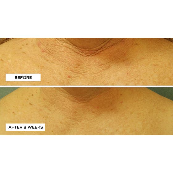 Cold Plasma+ Neck & Chest SPF 25