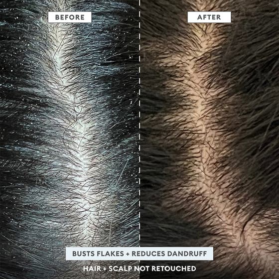 Scalp Revival™ Dandruff Relief Shampoo