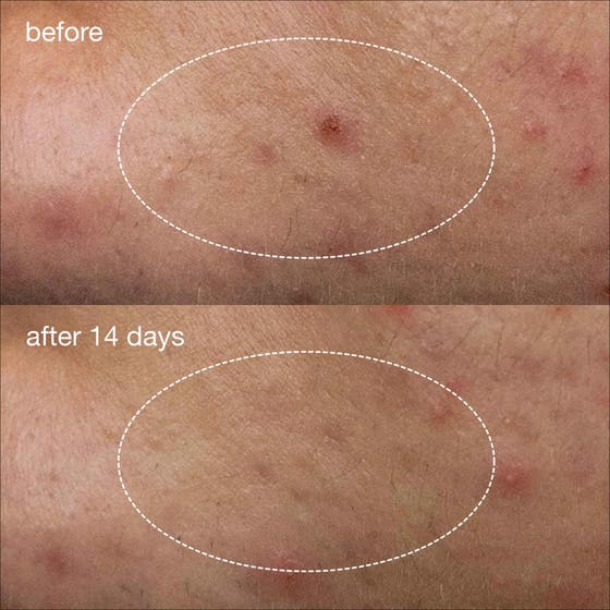 Deep Acne Liquid Patch