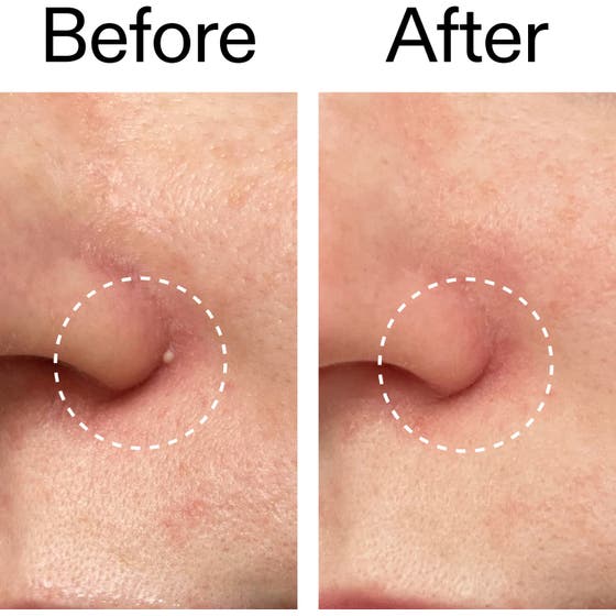 INKEY Hydrocolloid Invisible Pimple Patches