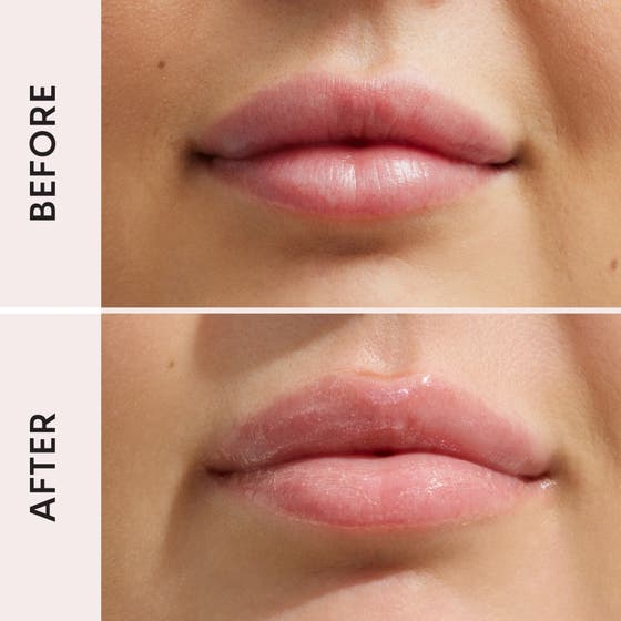 Lip Filler